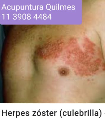 Tratamiento Zumbidos en oídos o Tinnitus Zona Sur Zumbidos en oídos o Tinnitus, Zona Sur Quilmes, Berazategui