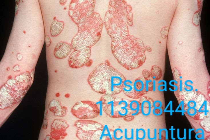 psoriasis ,Zona Sur Quilmes, Berazategui