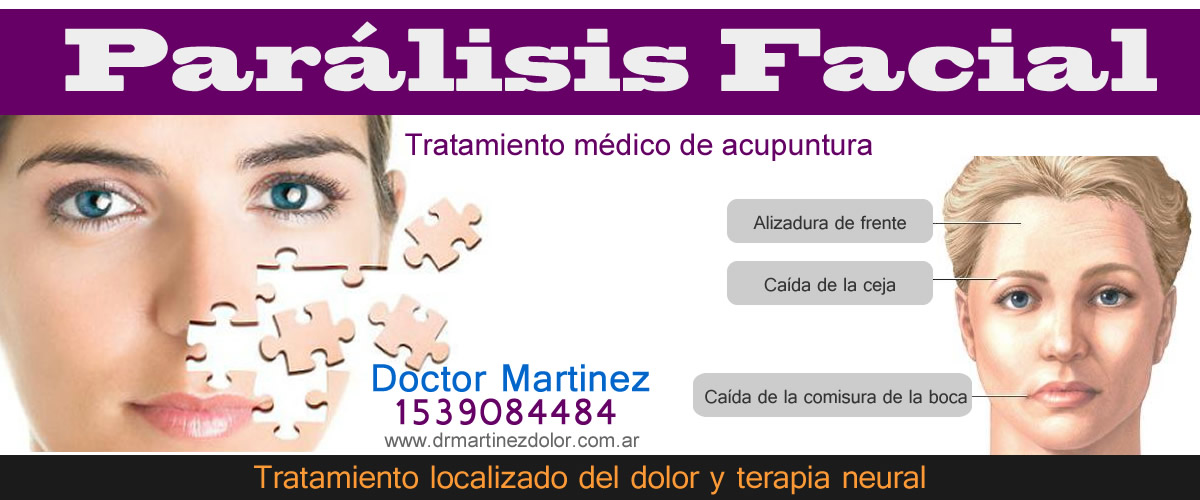 Paralisis FAcial Zona Sur