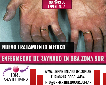 Nuevo Tratamiento de Enfermedad de Raynaud  Zona Sur Quilmes, Berazategui